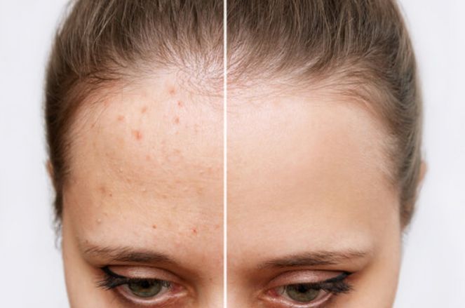 Before &After